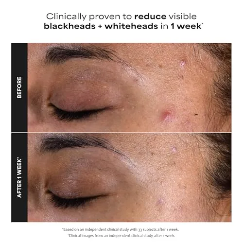 The Paula's Choice SKIN PERFECTING 2% BHA Liquid Exfoliant | Gentle in real use